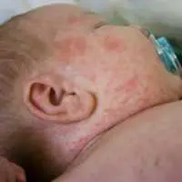 Eordaialive.com - Τα Νέα της Πτολεμαΐδας, Εορδαίας, Κοζάνης Πώς θα προφυλάξετε τα παιδιά σας από τις αλλεργίες που οφείλονται στις κάμπιες