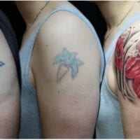 Μετανιώσατε για ένα τατουάζ; Τώρα μπορείτε να το αφαιρέσετε χωρίς κίνδυνο και αποτελεσματικά