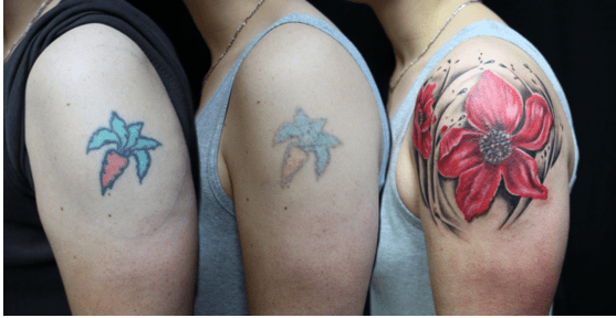 Μετανιώσατε για ένα τατουάζ; Τώρα μπορείτε να το αφαιρέσετε χωρίς κίνδυνο και αποτελεσματικά
