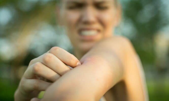 Τσιμπήματα κουνουπιών: Τι να κάνετε για να υποχωρήσουν γρήγορα