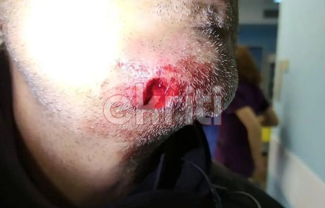 Eordaialive.com - Τα Νέα της Πτολεμαΐδας, Εορδαίας, Κοζάνης Κρήτη: Δάγκωσε στο πιγούνι αστυνομικό που τον σταμάτησε για έλεγχο και του έκοψε κομμάτι (ΦΩΤΟ)