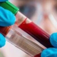 Καρκίνος του παχέος εντέρου: Νέα εξέταση αίματος τον ανιχνεύει με ακρίβεια - Eordaialive.com